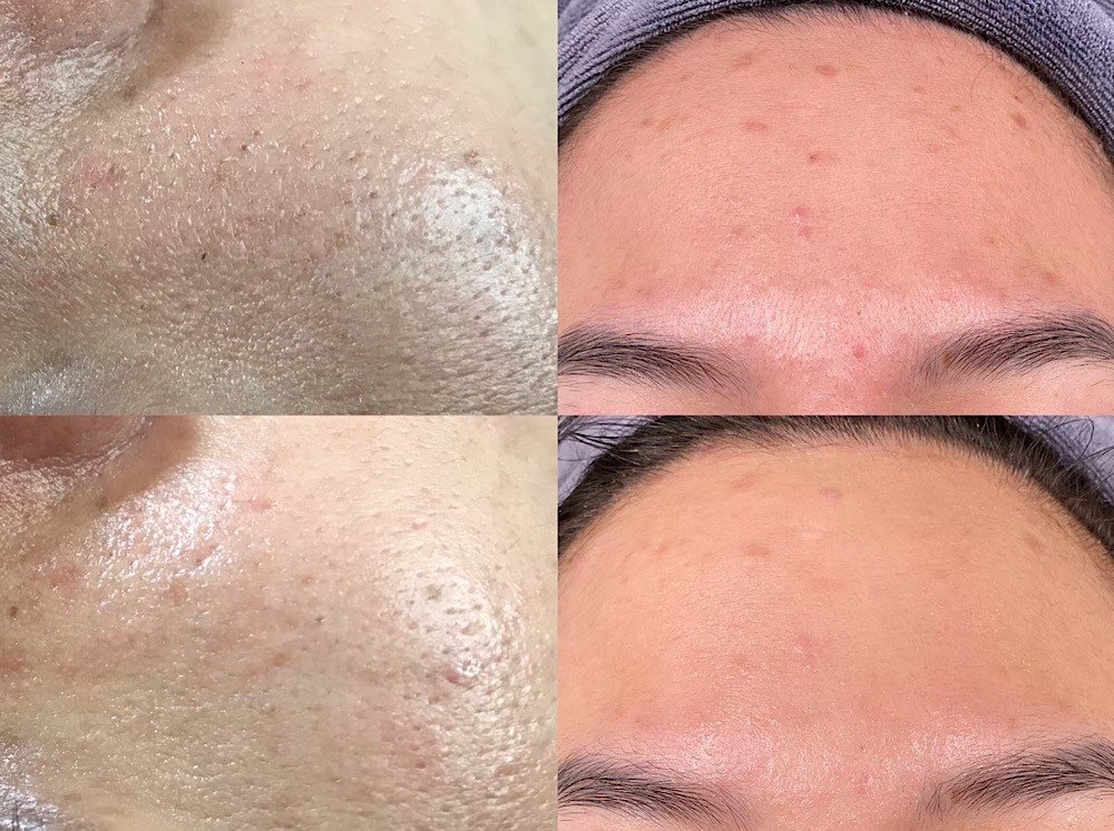 水飛梭,台北水飛梭,韓式綜合皮膚管理