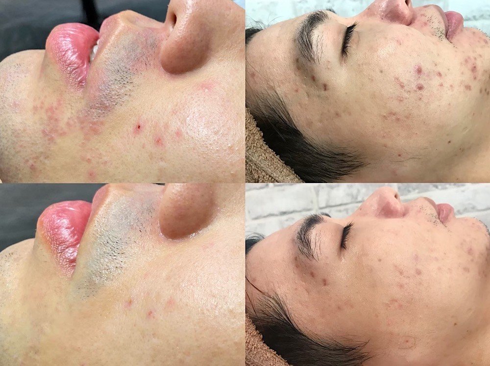客人皮膚案例-1