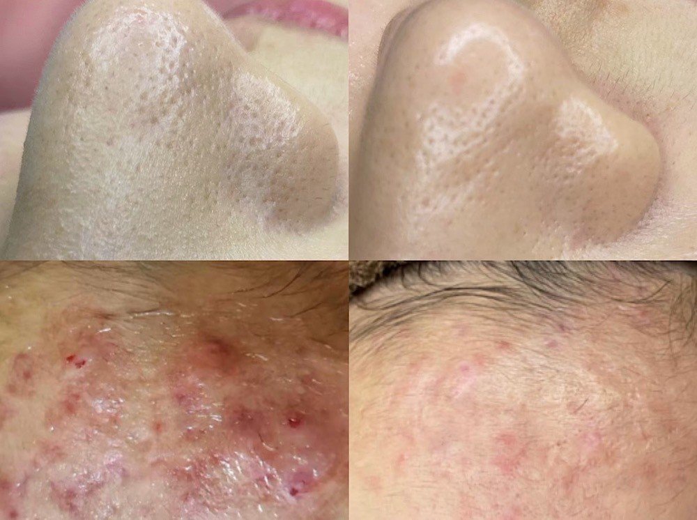 客人皮膚案例-2