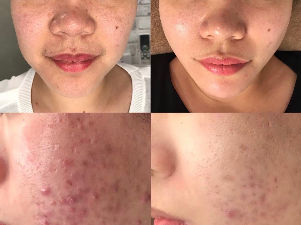 客人皮膚案例-3