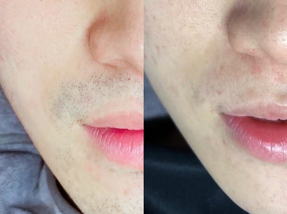 客人皮膚案例-5