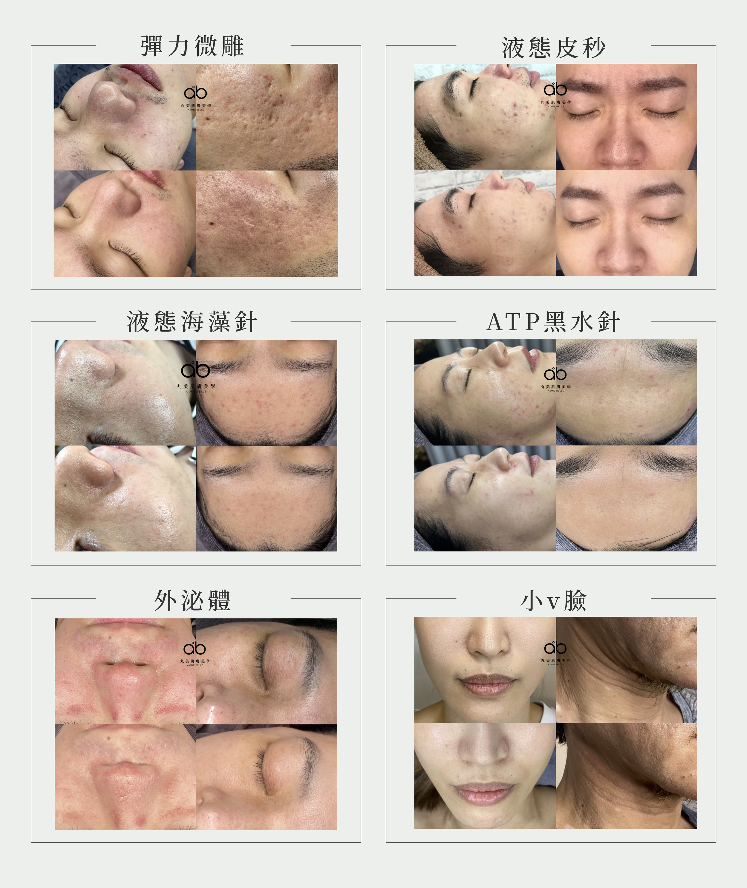 彈力微雕,液態皮秒,液態海藻針,ATP黑水針,外泌體,小V臉